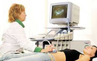 Удаление кисты яичника с помощью лапаротомии