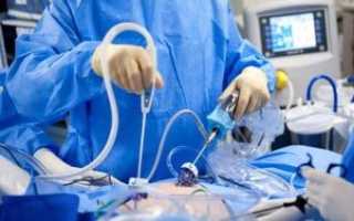 Почему врачи прибегают к лапаротомии в гинекологии