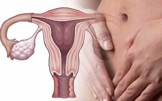 Особенности развития двухстороннего оофорита