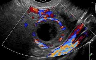 Чем опасны анэхогенные включения в яичниках