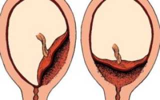 Плацента на 38 мм выше внутреннего зева