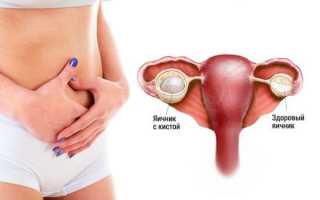 Как проявляет себя киста левого яичника