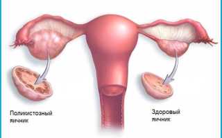 Процедура каутеризации парных половых желез женщины