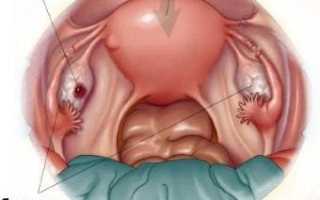 Опасные проявления фолликулярной кисты яичника