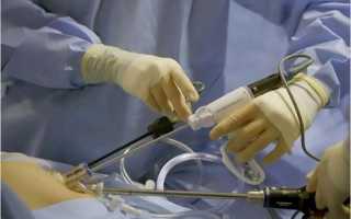 Нарушение цикла менструации при кисте яичника