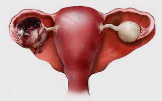 Последствия разрыва яичника у женщины