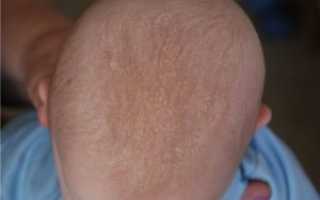 Появилась корочка на голове у ребенка