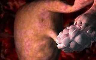 Возможно ли наступление беременности при синдроме истощённых яичников