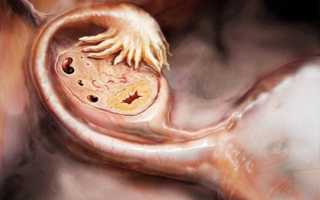 Причины увеличения женских яичников