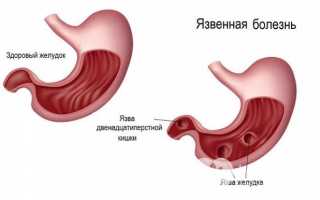 Причины, признаки и терапия язвы двенадцатиперстной кишки