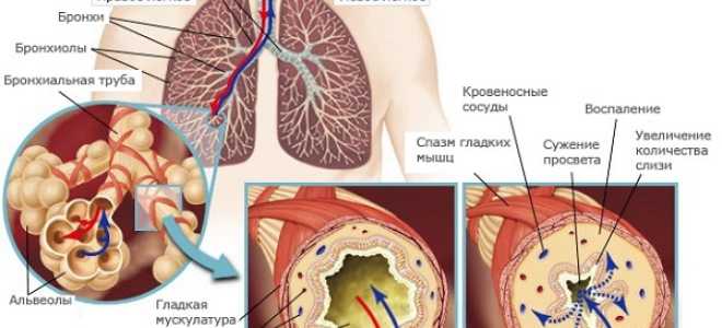 Что показывает анализ мокроты при бронхиальной астме?