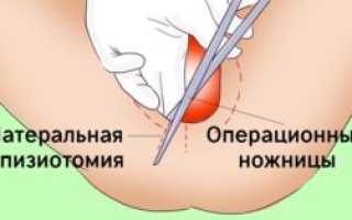 Как обрабатывать швы после эпизиотомии