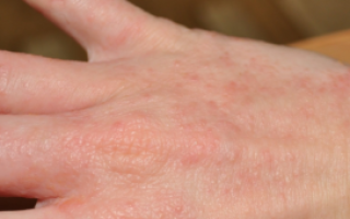 На руках аллергия на бытовую химию