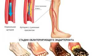 Облитерирующий эндартериит: лечение, симптомы и фото, стадии заболевания