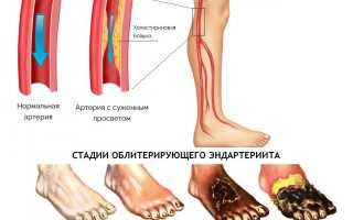 Облитерирующий эндартериит: лечение, симптомы и фото, стадии заболевания