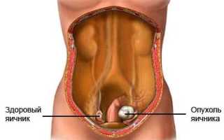 Разновидности опухолей яичника у женщин