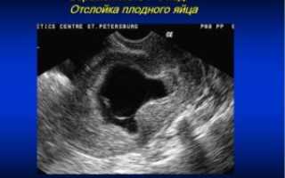 Отслойка плодного яйца лечение