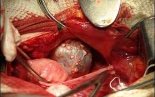 Особенности лечения кистомы левого яичника