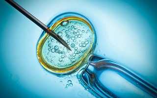 Развитие синдрома гиперстимуляции яичников при ЭКО