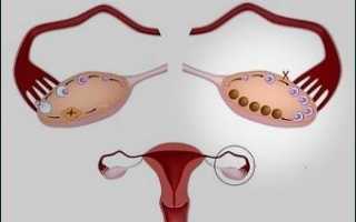 Основные признаки мультифолликулярных яичников и способы их лечения