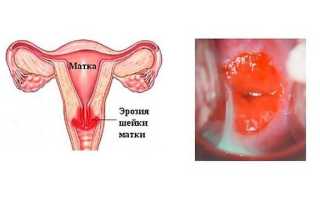 Применение свечей для лечения кисты яичника