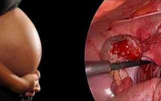 Как протекает беременность при апоплексии яичников