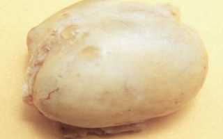 Особенности лечения кистомы правого яичника