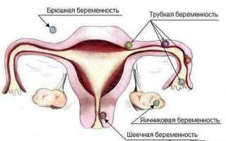 Причины появления яичниковой беременности и возможные её последствия