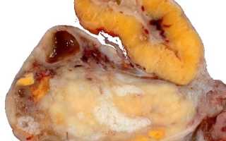 Симптомы разрыва кисты жёлтого тела яичника