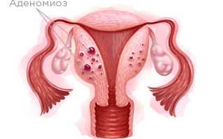 Признаки аденомиоза у женщины и способы его лечения