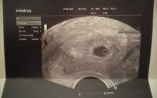 16 дпп пятидневок узи