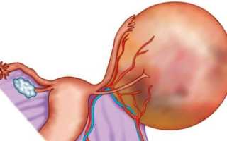Появление кисты яичника после климакса