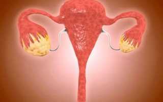 Признаки гипертрофии женских яичников