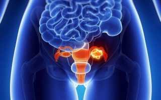 Основные признаки наличия кисты яичника у женщин и эффективные методы её лечения