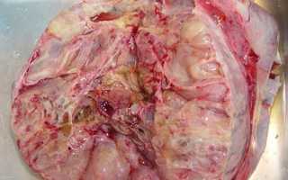 По каким признакам выявляют муцинозную цистаденому яичника