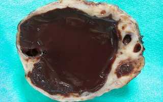 Эндометриоидное кистозное образование яичника