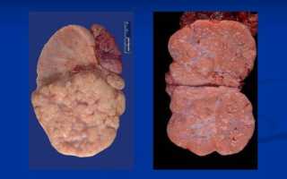 Причины появления дисгерминомы яичника и действенные способы её терапии
