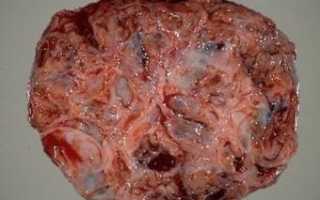 Особенности и виды гранулезоклеточной опухоли яичника