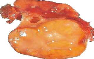 Какие методы лечения помогают при текоме яичника