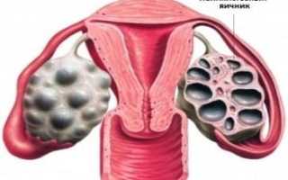 Здоровое питание при поликистозе и меню на каждый день