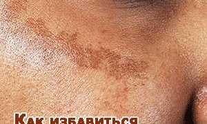 Как избавиться от пигментных пятен на лице