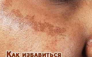 Как избавиться от пигментных пятен на лице