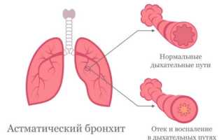 Астматический бронхит — симптомы и лечение у детей и взрослых