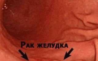 Лечение народными средствами рака желудка