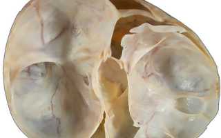 Особенности строения и виды муцинозной кисты яичника