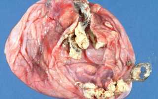 Диагностика и лечение дермоидной кисты яичника
