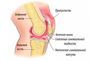 Синовит коленного сустава. Жидкость в коленном суставе причины и лечение