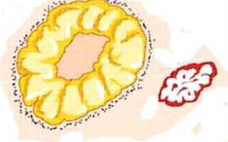 Влияние кисты жёлтого тела на течение беременности