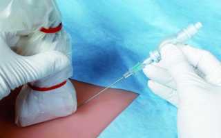 Для чего проводится биопсия яичников