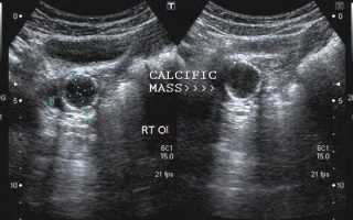 Что означают кальцинаты в яичниках на УЗИ